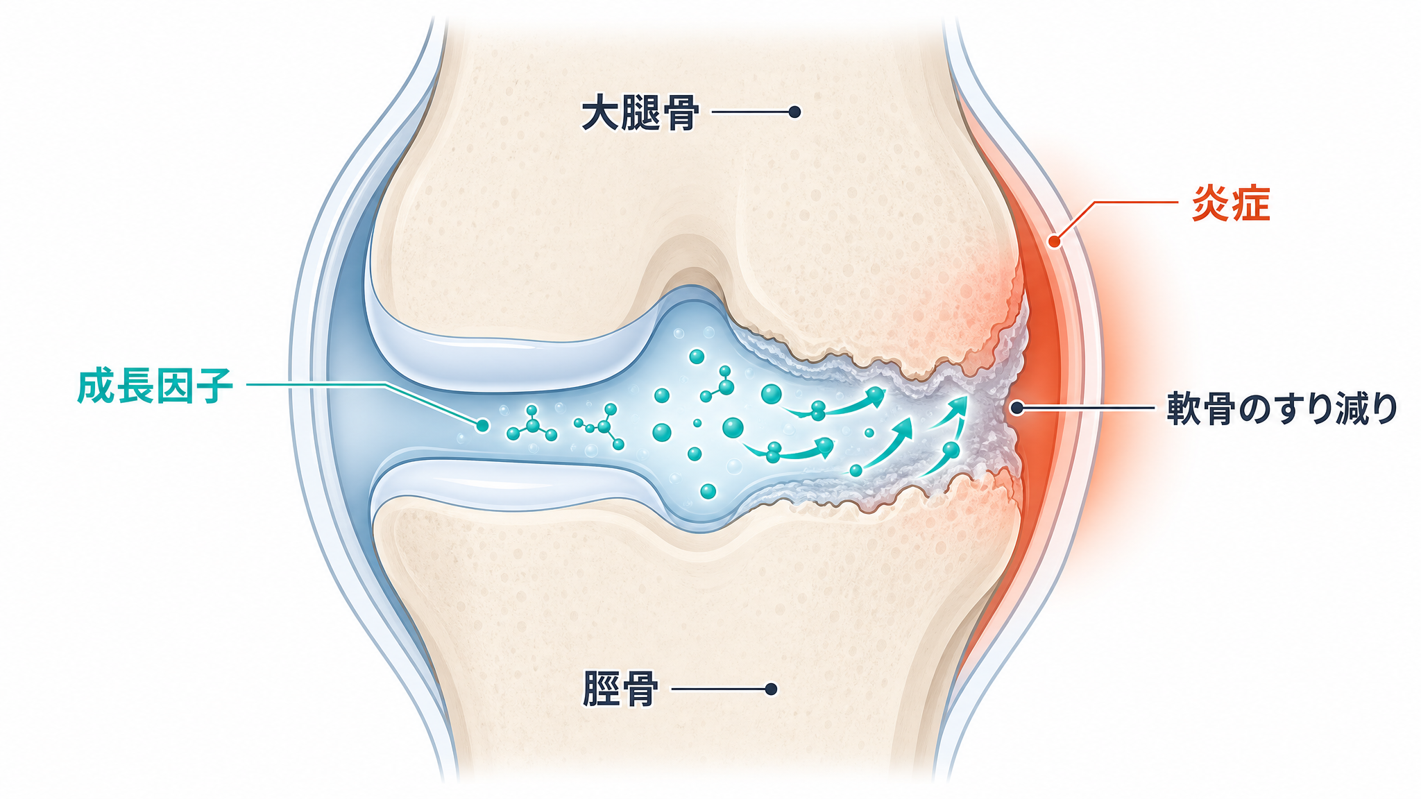 膝関節の断面図。軟骨がすり減り炎症が起きている部分に、骨髄由来の成長因子が働きかけて修復環境をつくる様子を示す概念図